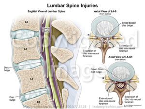 Lumbar Injuries - Legal Graphicworks