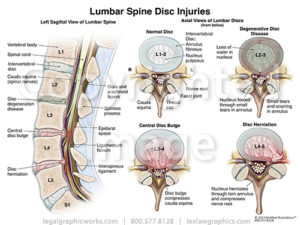 Lumbar Spine Disc Injuries - Legal Graphicworks